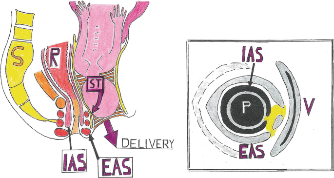 Diagrams of the delivery trauma caused due to anal incontinence. The diagram on the left, labels the long bony structure S, a passage as R, and the muscles on both sides of R near the opening as I A S and E A S. A fetus has reached the opening of the vagina for delivery. The second diagram is a longitudinal view of the first.