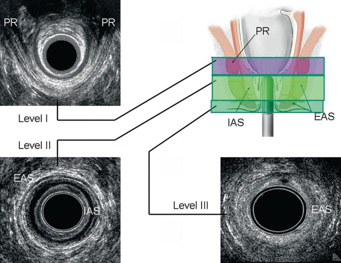 The ultrasonography of the anal canal of 3 levels. In level 1, the puborectalis muscle around the anal canal. In level 2, the internal and external anal sphincter are ring like structures around the canal are visualized. In level 3, the external anal canal is denser around the canal. The layers of muscles are shown in the anatomy of the canal.
