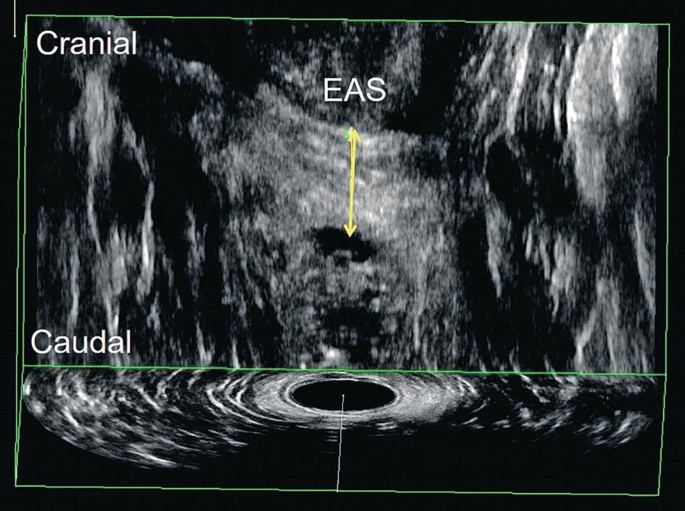 The ultrasonography of the anal canal and soft tissue is visualized. The external anal sphincter is anechoic. This is a caudal cranial view of the patient.