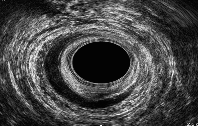 The ultrasonic image of the canal is anechoic and the anal sphincters in a ring like pattern are denser looking around the canal. A hypoechoic lesion is seen at the canal.