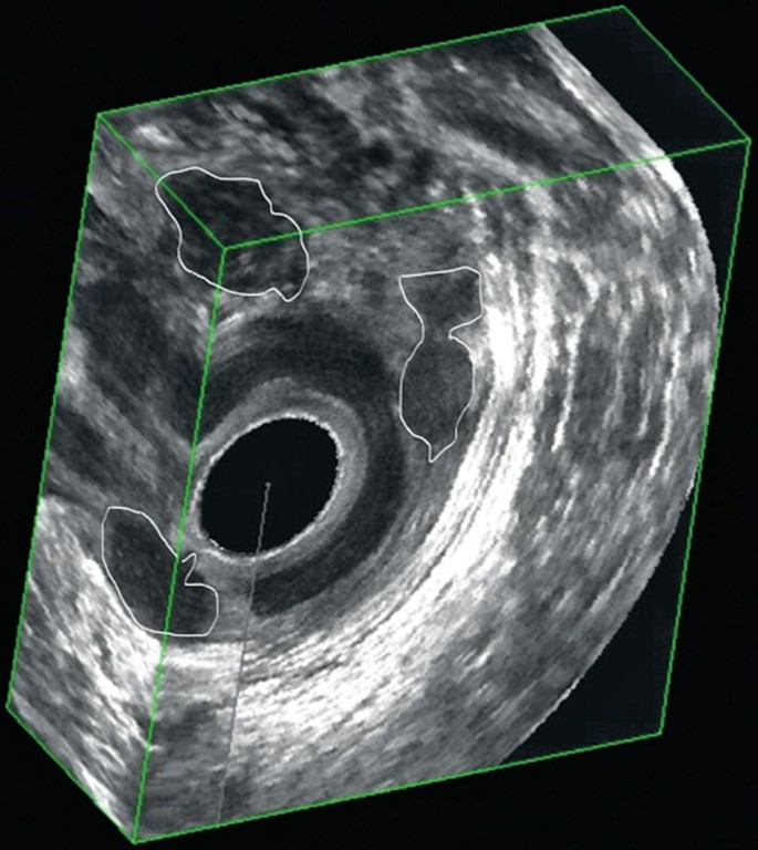 A 3 dimensional view of a slice from the anal canal ultrasonography. Some hypoechoic spaces are seen near the sphincters that are highlighted.