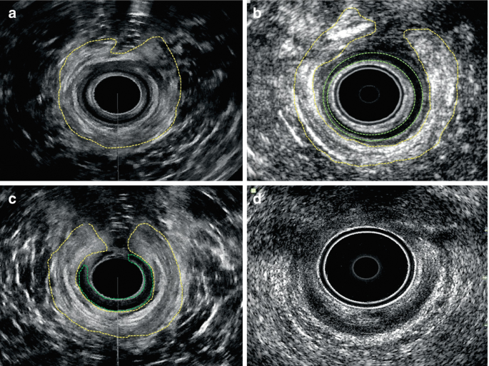 The ultrasonography of the anal canal to look for sphincter injuries. In part a, the hypoechoic part is outlined and is irregular. In part b, the canal has an irregular boundary around the canal one is concentric and the outer region is irregular and denser. In part c, more region is denser and U shaped. Part d, the anal canal and lesion is seen.