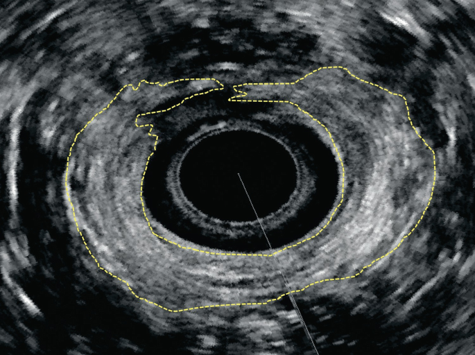 The ultrasonography of the anal canal with a denser region and an irregular boundary around it, defect of the sphincters is visualized.