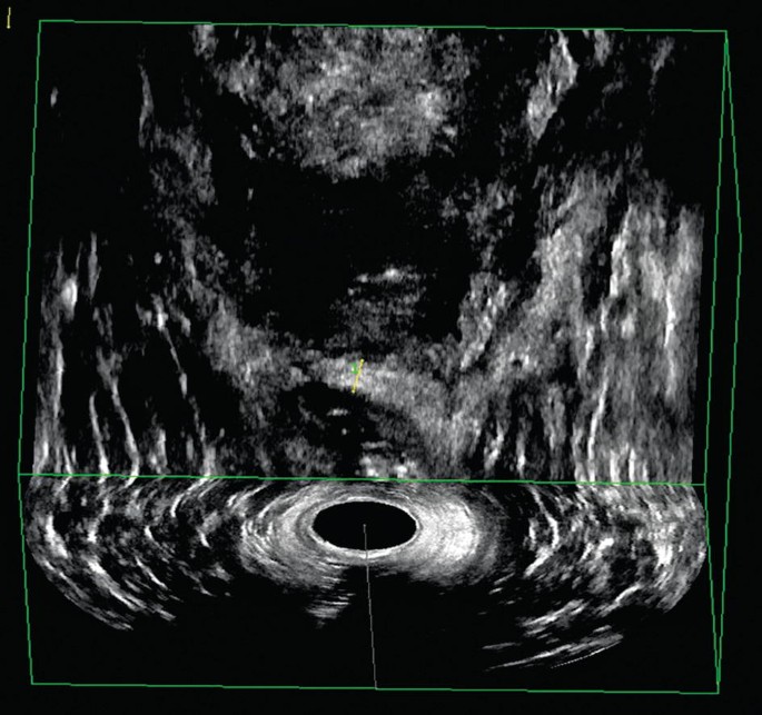 The Ultrasonography of the anal canal and the soft tissue is visualized and the hyperechoic region around the anal canal.