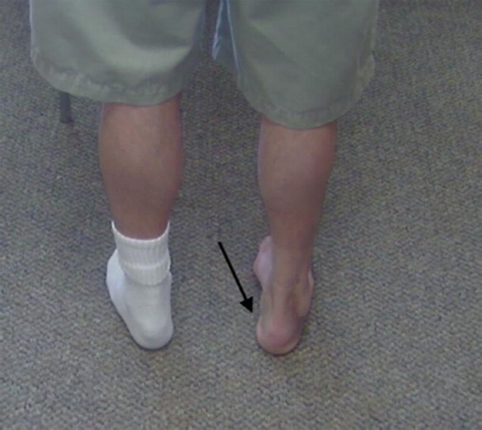 Utilizing Manual Therapy With Exercise Improves Outcomes In Patients With  Chronic Ankle Instability - Mend Colorado