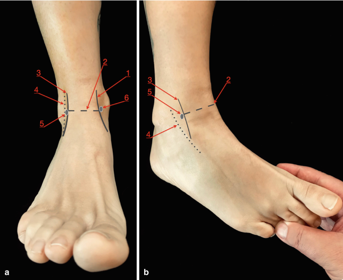 deltoid ligament ankle sprain