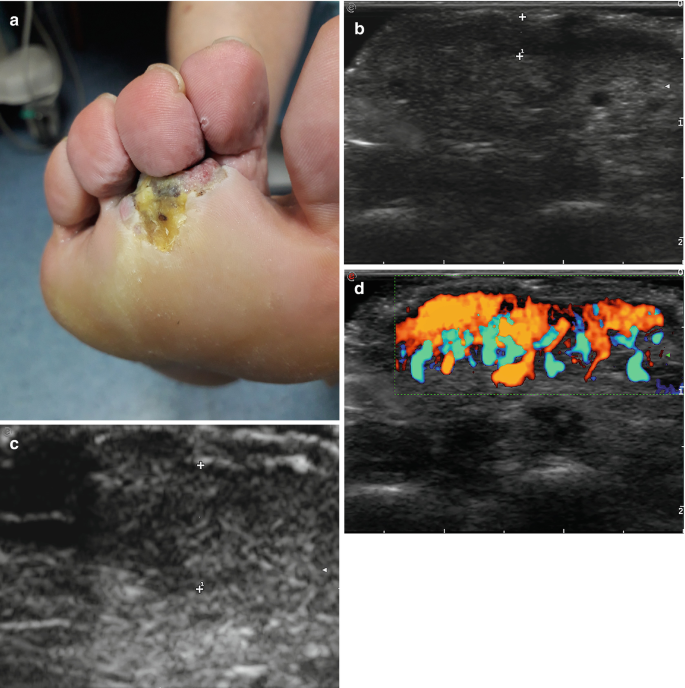 A set of 4 images. A. Photo of the lower side of the foot with a lesion present below the toes. Scanned image with a dark background with horizontal light shaded patches. C. Image with a hazy light shaded central region with a dark region on the top left. D. A scanned image with multiple shaded regions on the top part.