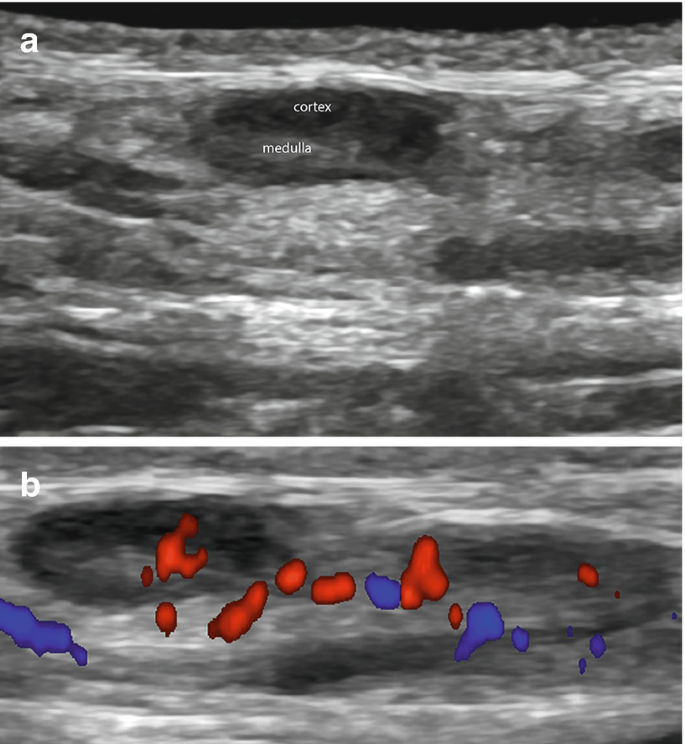 Two ultrasonic images of a lymph node depict the hypoechoic cortex and medulla beneath it, with marked blood flow through Doppler.