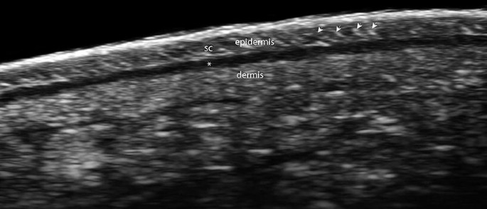 An ultrasonic image of the plantar skin depicts a hypoechoic layer between the epidermis and dermis, and a hyperechoic band with a stratum corneum in the epidermis.