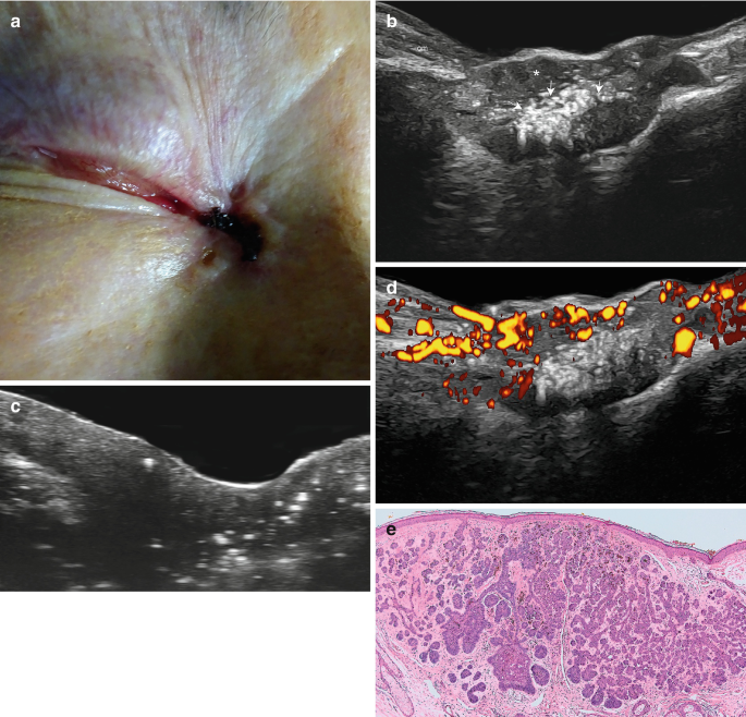 The image a b c d and e represent basal cell carcinoma clinical image, grayscale, power doppler, and histology proliferation.