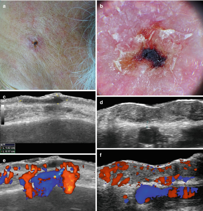 The image a b c d e and f represent squamous cell carcinoma clinical image, dermoscopy, grayscale, color doppler, and hypoechoic dermal.