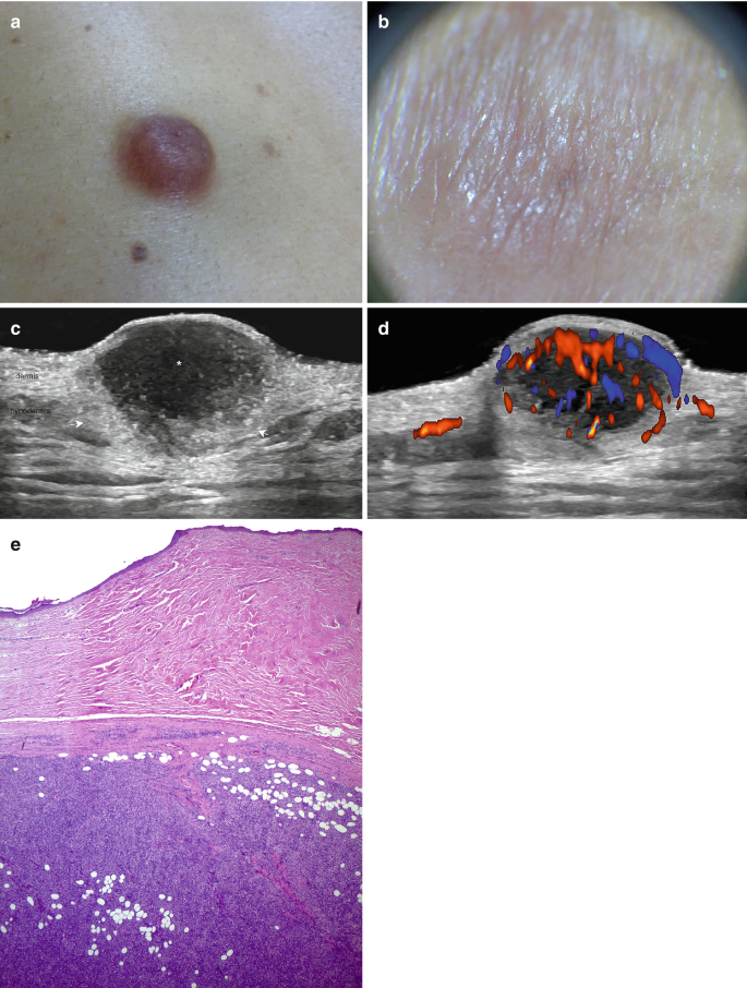 The image a b c d and e represent dermatofibrosarcoma protuberans clinical, dermoscopy vision, color doppler, histology, and hypodermal.