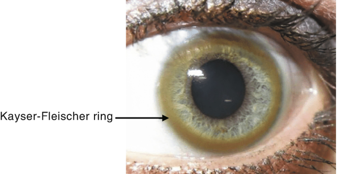 Is this a KF ring - Wilson disease