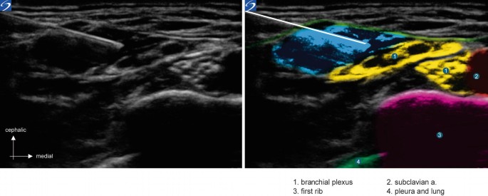 2 ultrasound scans in cephalic versus medial view. The components in the right scan are labeled 1 to 4 as brachial plexus, subclavian a, first rib, and pleura and lung.