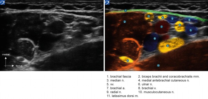 2 ultrasound scans in medial versus dorsal view. The components in the right scan are labeled 1 to 11 as brachial fascia, median n, ulnar n, radial n, brachial v, and so on.