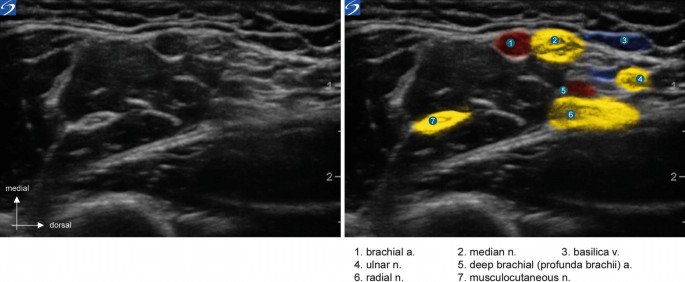 2 ultrasound scans in medial versus dorsal view. The components in the right scan are labeled 1 to 7 as brachial a, median a, basilica v, ulnar n, deep brachial, radial n, and musculocutaneous n.