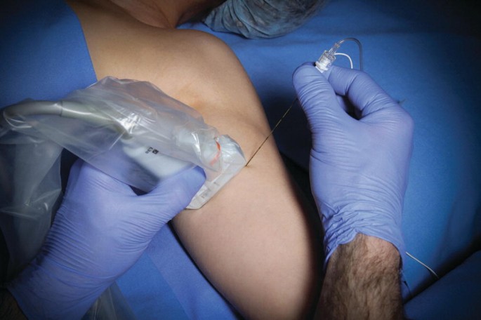 A photograph illustrating the hands of a medical professional positioning a probe under the arm of a patient and injecting a needle at the position.