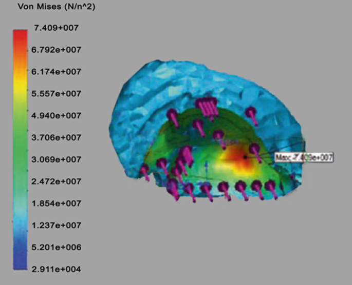 A radiograph of the acetabular cup shows Von Mises stress regions. The scale ranges from 2.911 e plus 004 to 7.409 plus 007 in capital N over lowercase n to power 2.