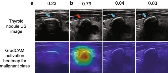 Two sets of four microscopic images. The images are arranged in two rows and four columns. First row depicts the thyroid nodule U S image. Second row depicts Grad CAM activation heatmap for malignant class. Above the four columns from left to right are the numbers, 0.23, 0.79, 0.04, 0.03.