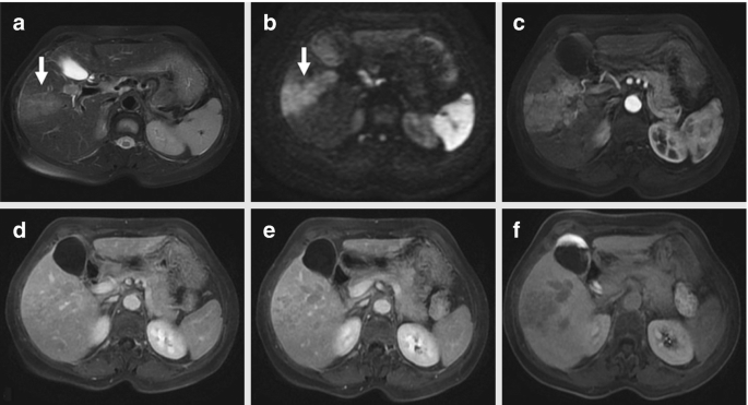 Six radiological images of the liver cancer in cross-sectional view, In image a, an arrow points to a bright lesion on the left. In images b and c, the lesion appears to have diffused within the membrane. In images d, e, and f, the lesion appears faint against the brightly illuminated liver.