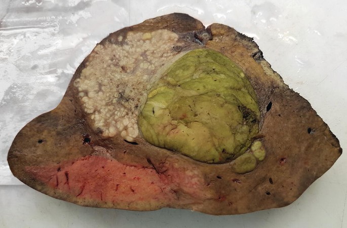 A photo of a cancerous liver lesion. A bulbous tumor-like growth on the upper part is covered with bile, a dark-colored liquid.