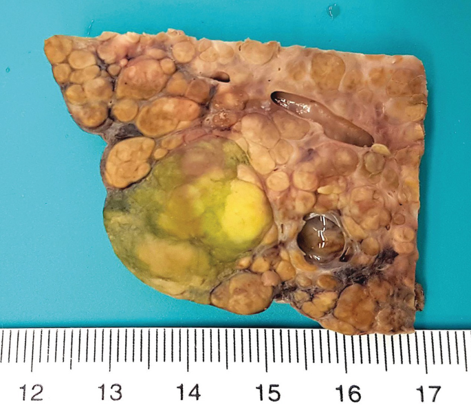 A photo of a scarred liver. There is a big bulbous structure near the center covered with bile.