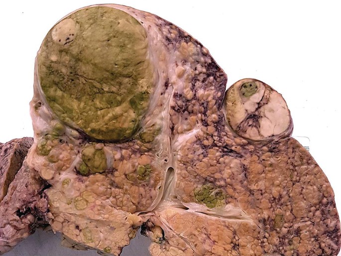 A photo of a scarred liver with lesions. On the right, a nodule-like structure extends from the surface giving it a distinct appearance.