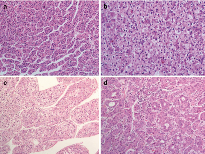 Four microscopic images of liver carcinoma display the histomorphologic features. In image a, thick hepatic cords are surrounded by stained cells. In image b, the stained cells are compact. In image c, clusters of stained cells with gaps in between. In image d, open spaces are lined by stained cells.