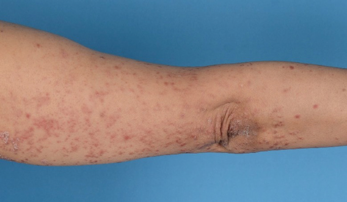 A photo of an arm and elbow region. There are multiple bright spots all over the skin.