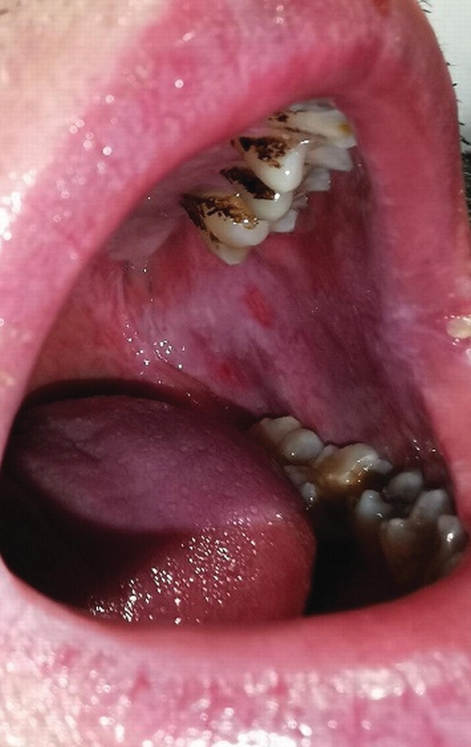 A photo of an open mouth with visible red marks in the buccal cavity and plaque over the teeth.