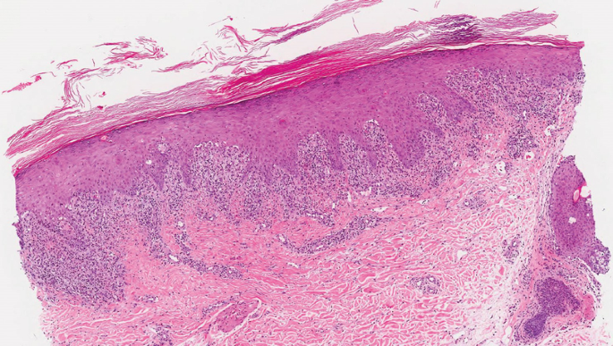 A histological study of the cells. It has a dark upper margin and lightly stained cytoplasm. The skin surface is wedge-shaped and cornified.