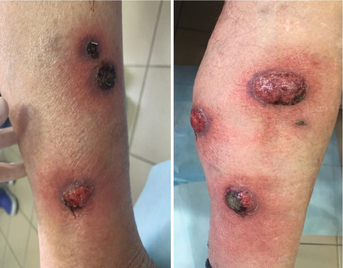 A 71-Year-Old Man with Blisters on the Face and a Painful Left Thigh