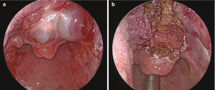 Two photos. a, depicts the larynx with a vallecular cyst. b, depicts the larynx post C O 2 laser excision of the vallecular cyst.