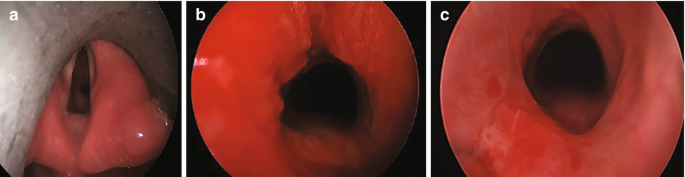 3 photos. a, depicts GPA of the larynx with subglottic stenosis. b, depicts larynx immediately post balloon dilatation and steroid injection. c, depicts the larynx after the procedure.