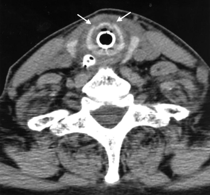 A CT image of computed tomography of display dark and light regions with cricoid fracture.