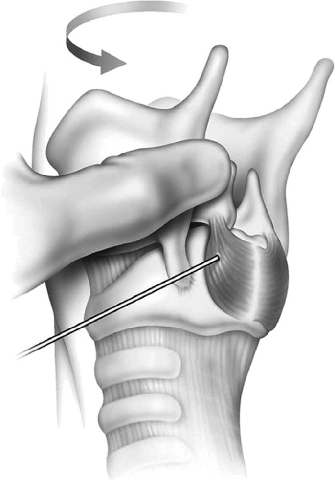 An illustration of the lateral view of the trachea and a needle injected directly into the muscle behind the rings.