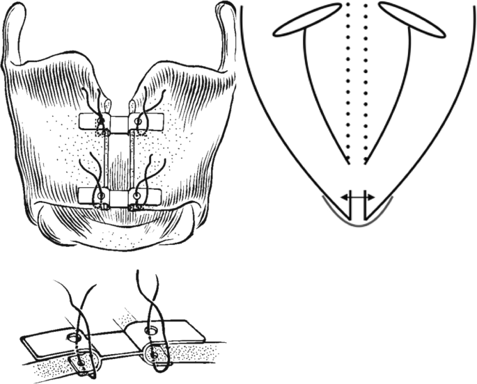 An illustration of the tracheal head with a fracture that is held together by means of 2 horizontal bars.