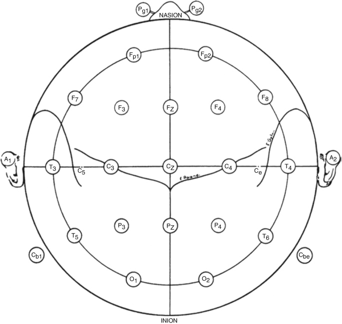 An image depicts the single-plane projection of the head and the fissures' locations.