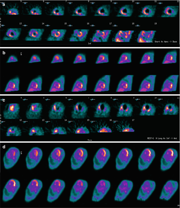 An image illustrates the P E T-C T scan of the chest and the heart with technician 99 tracer. The light areas depict the areas with the lesion.