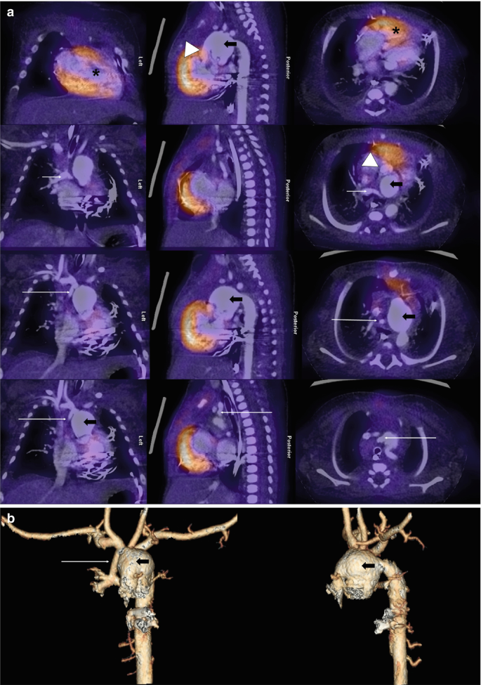 An illustration of multiple P E T-C T scans of the thorax in different views highlights the areas of the lesion in the heart. The two pictures at the bottom illustrate a 3-D C T scan of the heart.