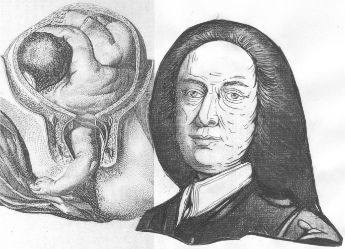 A diagram of William Smellie and a placenta where the fetus's head, limbs, backside, and legs are visible.