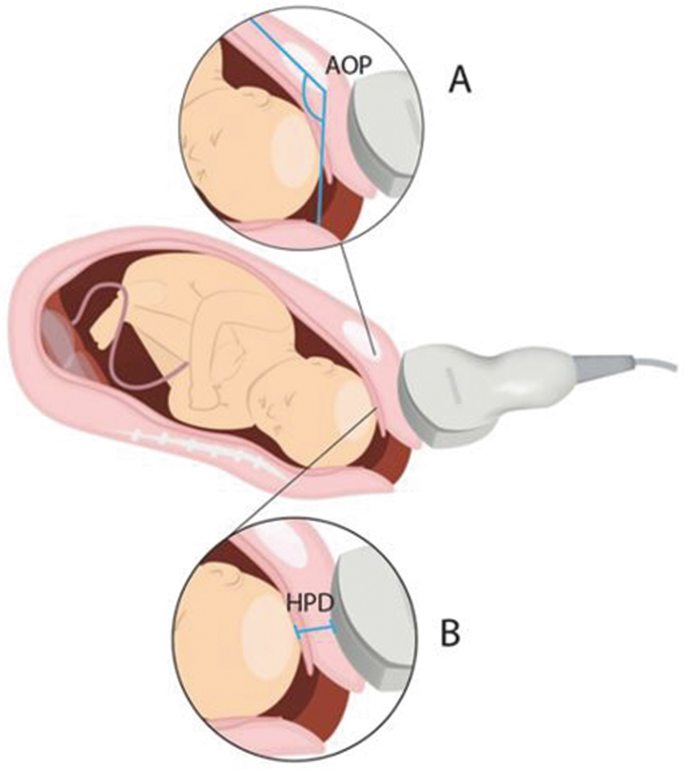 Birth Simulation Of A Breech Delivery : r/Damnthatsinteresting