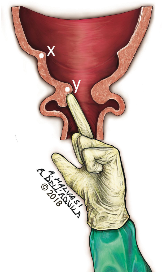 Uterine Rupture: A Rare Event But Terrible to Know How to Face |  SpringerLink