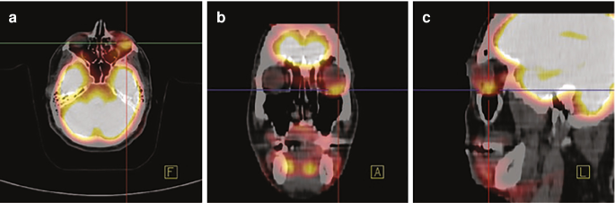 A scanned image of intense F D G uptake shown in a bulky mediastinal mass and an interim PET after two cycles of A B V D.