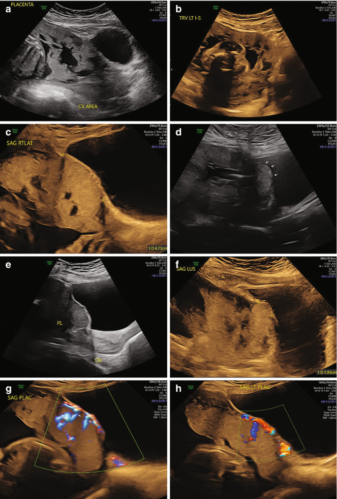 Eight ultrasound images of the placenta labeled a to h.