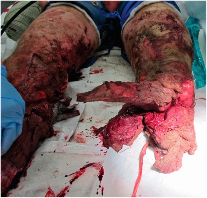 Traumatic Amputation | SpringerLink