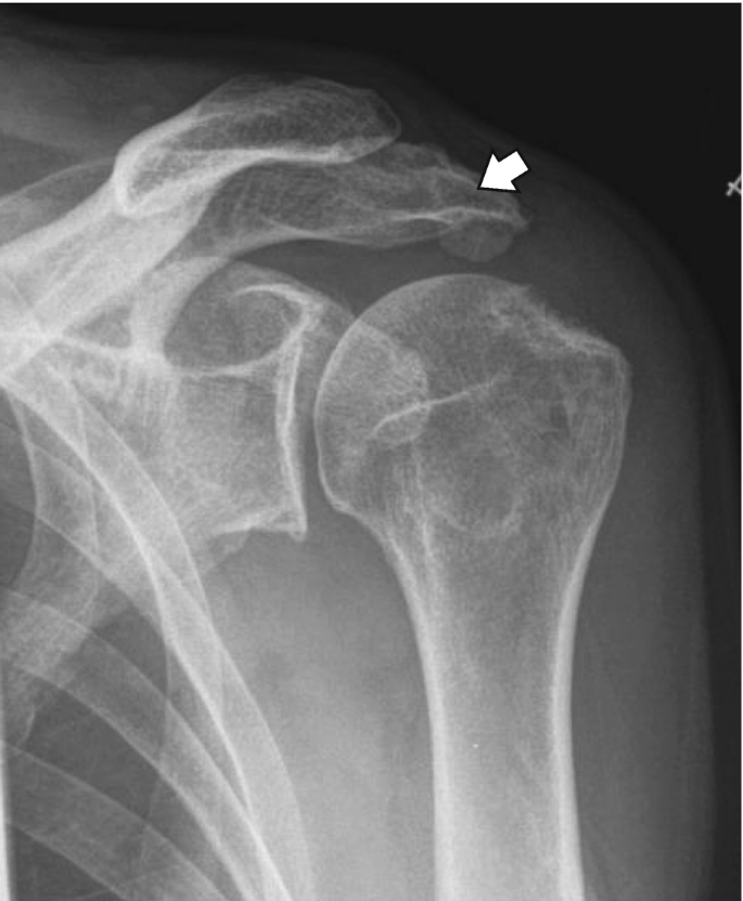 Radiographic Features of Rotator Cuff and Biceps Tendon Pathologies |  SpringerLink