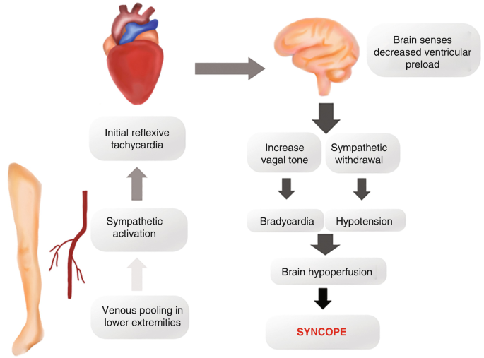 A flowchart of vasovagal syncope. The flow starts with venous pooling in lower extremities, initial reflexive tachycardia, brain senses decreased ventricular preload, and ends with syncope.