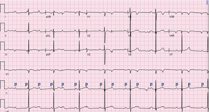 A E C G for the atrioventricular block has 6 frequency curves. The fifth curve is labeled P throughout the chart.