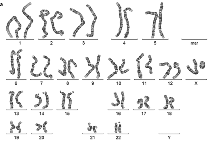 Clinical and cytogenetic analysis of terminal 22q13.3 deletion in two  patients with ring chromosome 22 Ismail S, Kamel AK, Ashaat EA, Mohamed AM,  Zaki MS, Aboul-Ezz EH, Hammad SA, Sayed IS, El